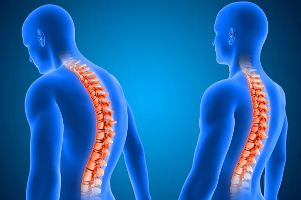 Spinal Deformity Correction